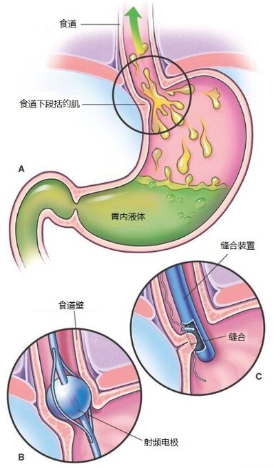 胃食管反流图解图片