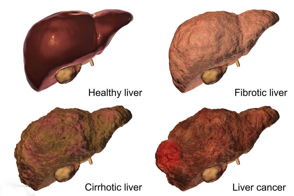 肝纤维化和肝硬化有什么区别?