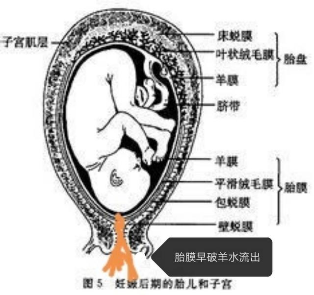 孕妈妈如何应对胎膜早破?
