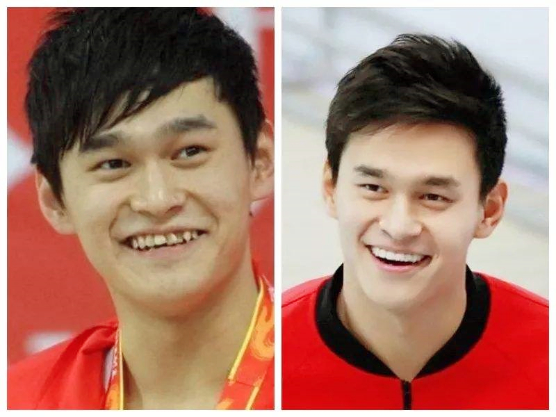 孙杨的"鲨鱼牙"问题?