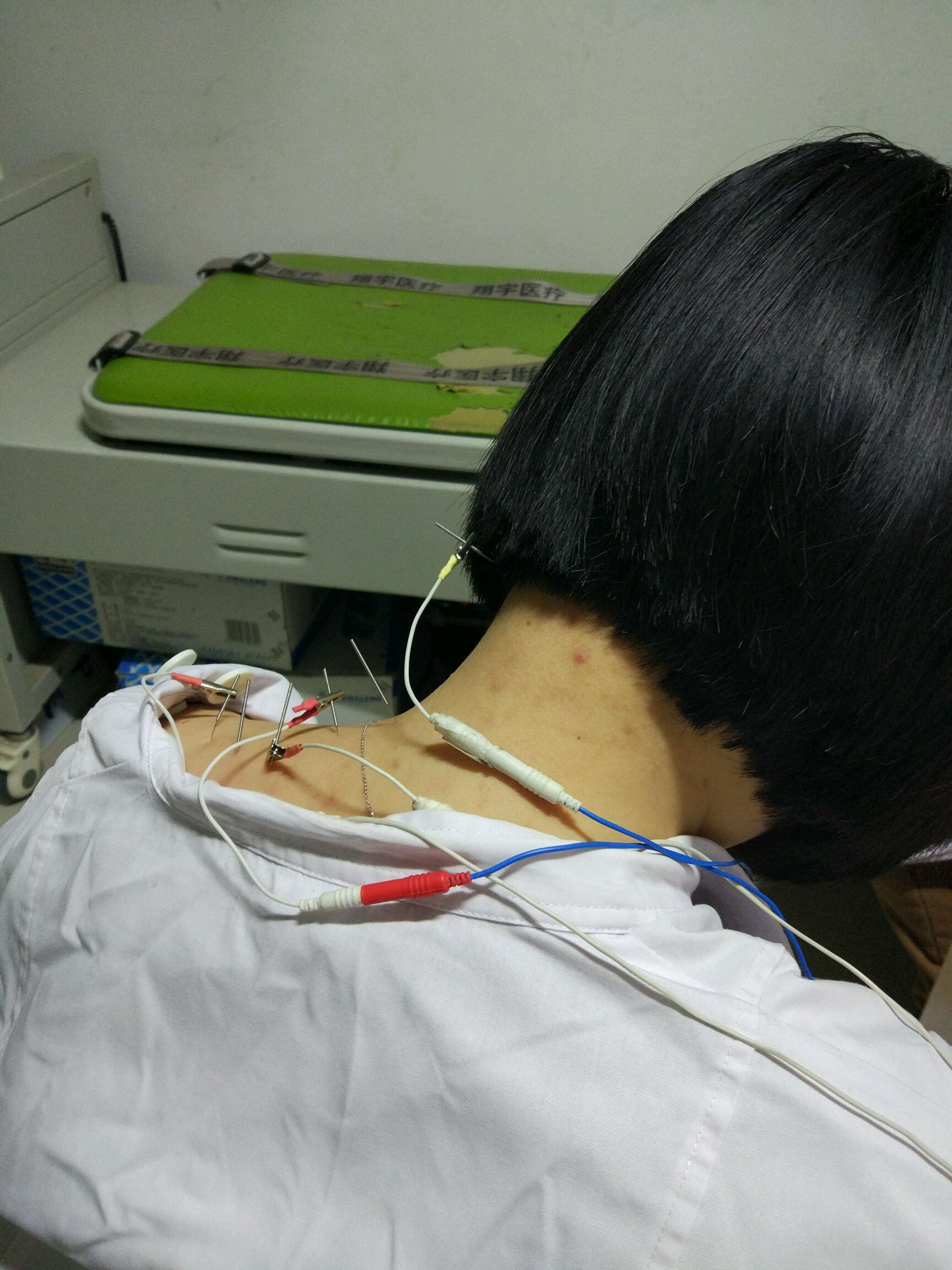 电针治疗颈椎病