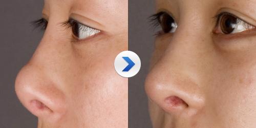 假体隆鼻老了会变型吗