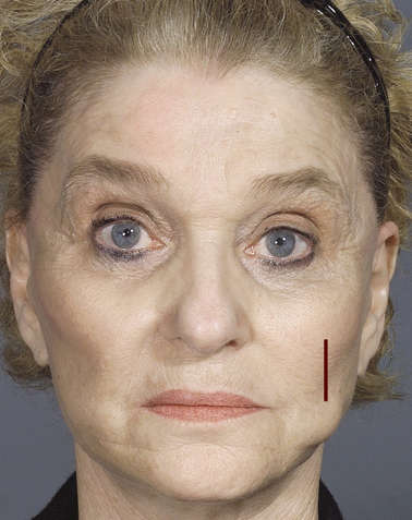 颊部鼓满,圆脸,呈现"孩童样","婴儿肥"脸大,适合