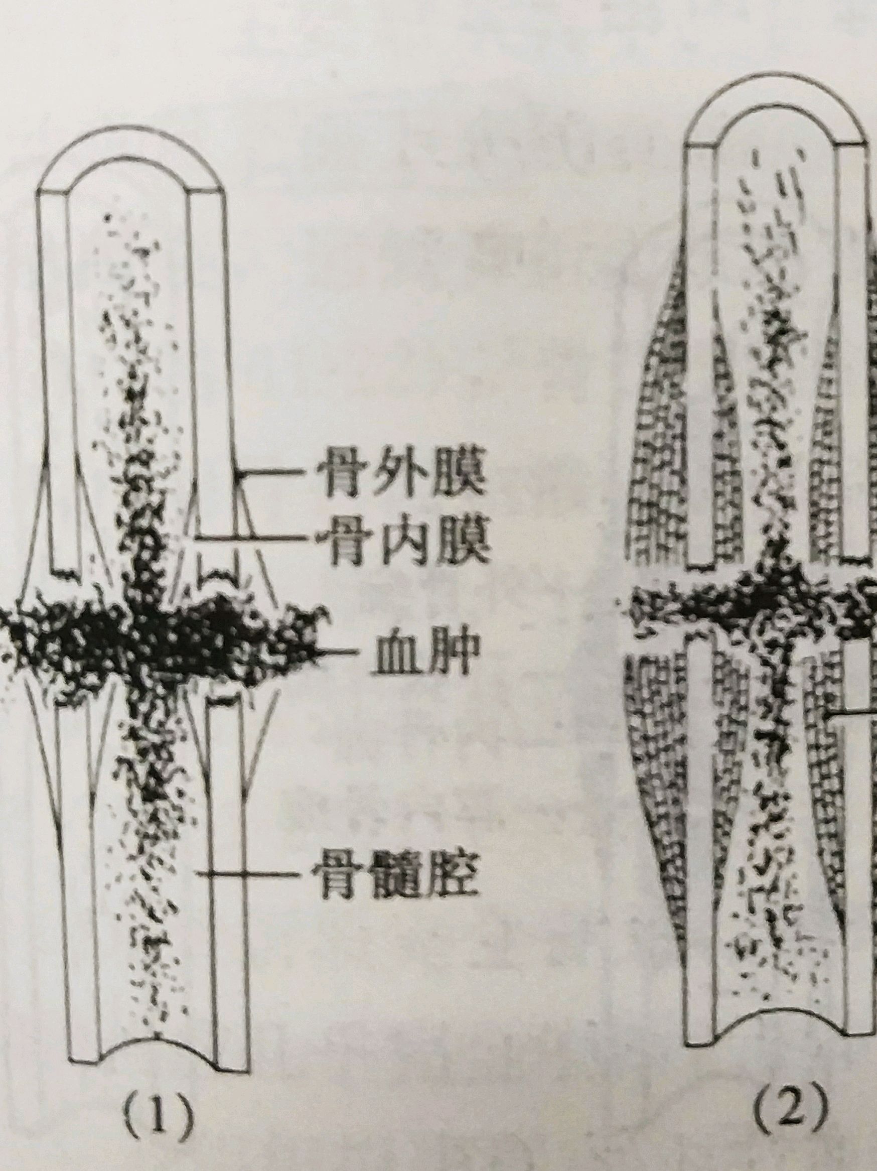 骨头愈合过程示意图图片