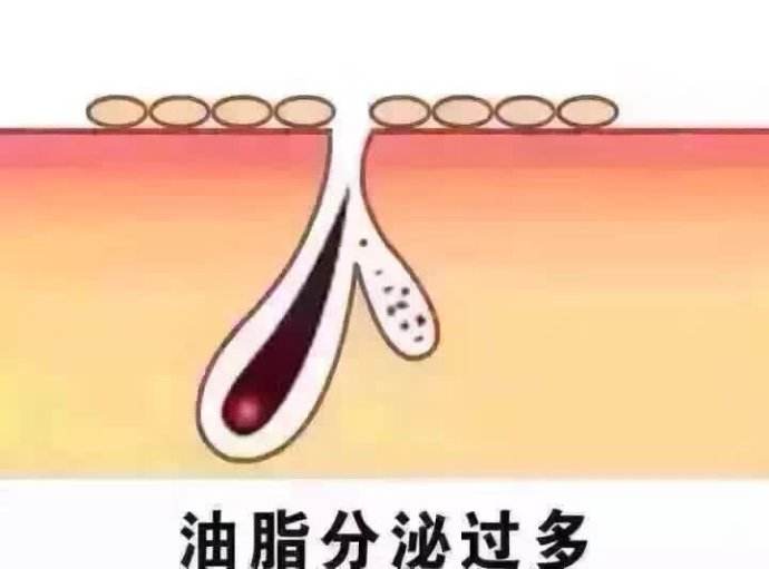 夏季的油惑夏天皮肤为啥爱出油