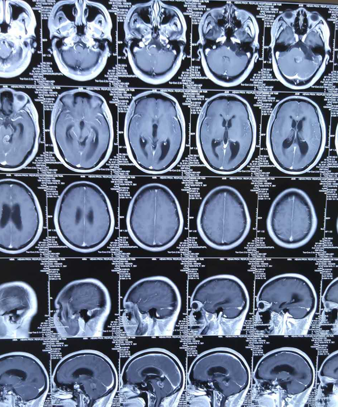 患了脑部肿瘤怎么办才好