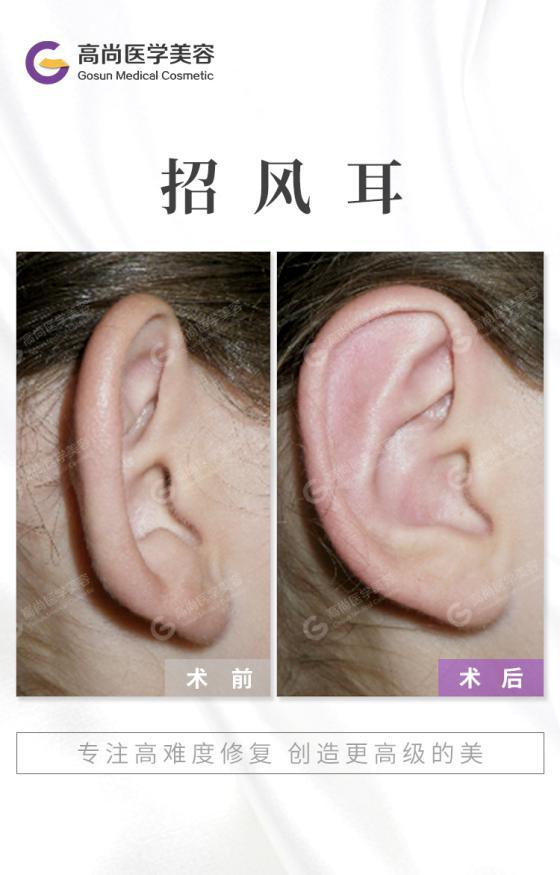 招风耳,即耳壳角度大于90度,通常都在150度以上,有些病人的耳朵甚至会