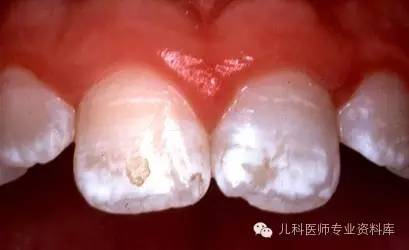 导致牙釉质上的钙流失超过沉积,从而导致牙齿表面出现白色或黄色的