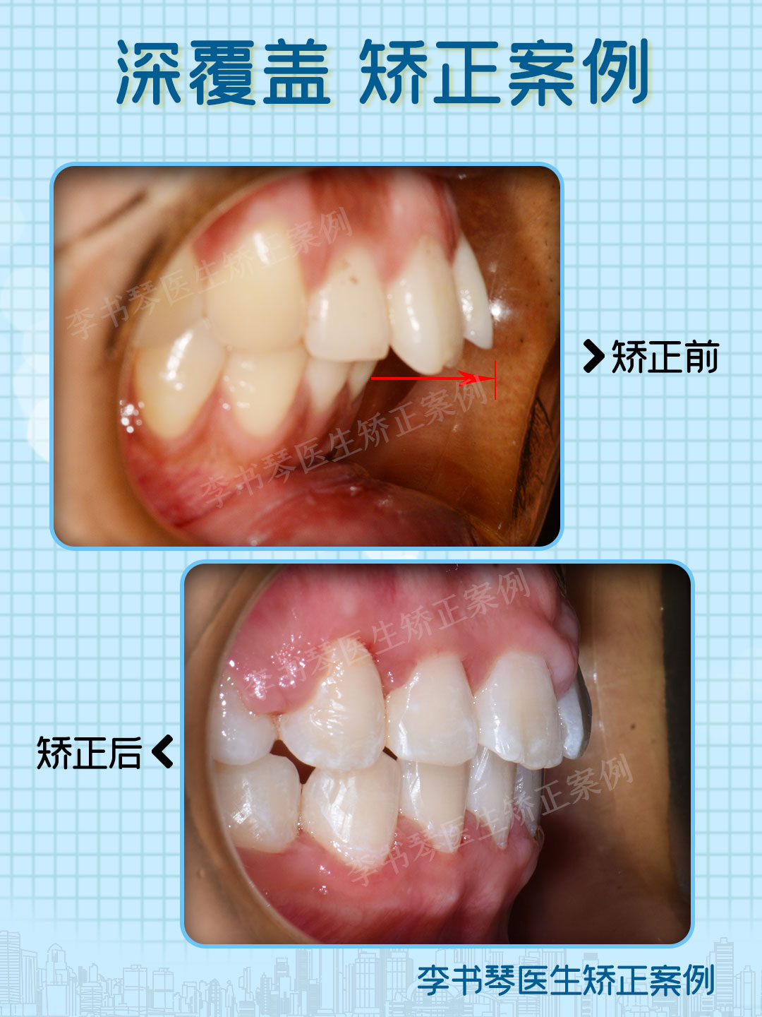 ◤drli案例分享◢深覆盖龅牙非拔牙矫正