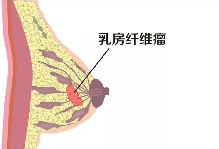 因此建议乳房的纤维腺瘤在有手术指征之后,还是应该尽早的进行手术