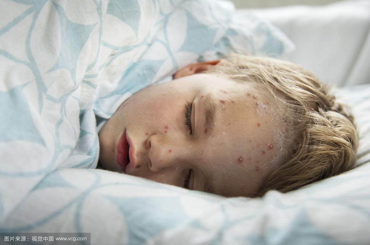 水痘可以吹风吗需要注意哪些