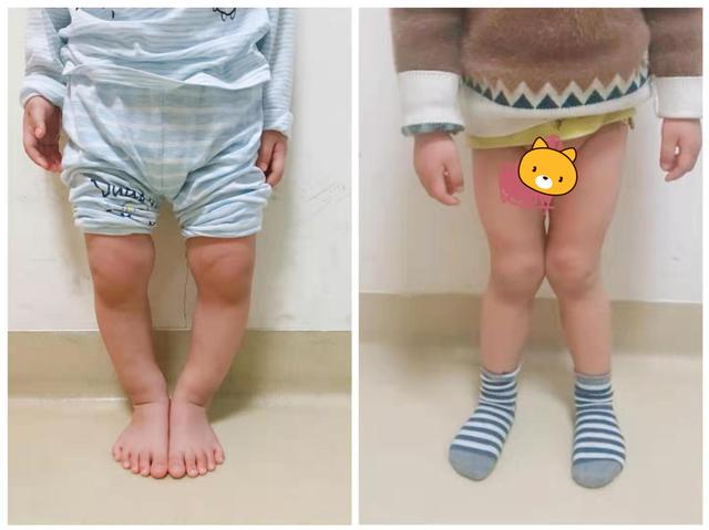 小孩腿型发展正常图片图片
