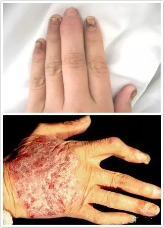 (一)尋常型銀屑病(psoriasis vulgaris)分為尋常型,關節病型,膿皰型