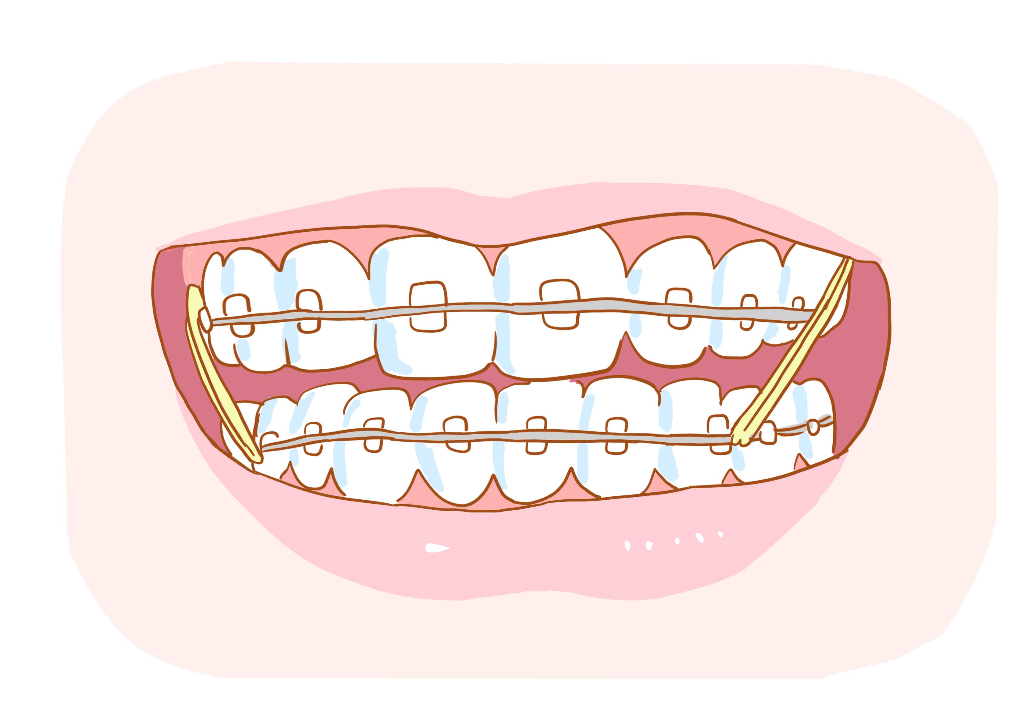 正畸皮筋的作用图片