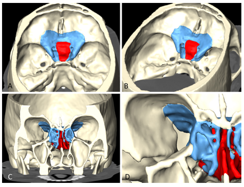 内镜下鼻内经鞍结节及蝶骨平台入路外侧边界的确定: 附加相关定