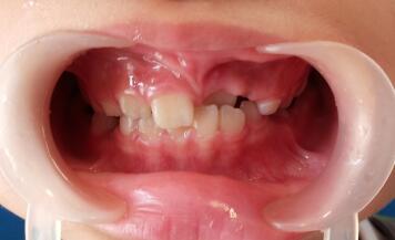 这20种儿童牙颌畸形矫正别犹豫