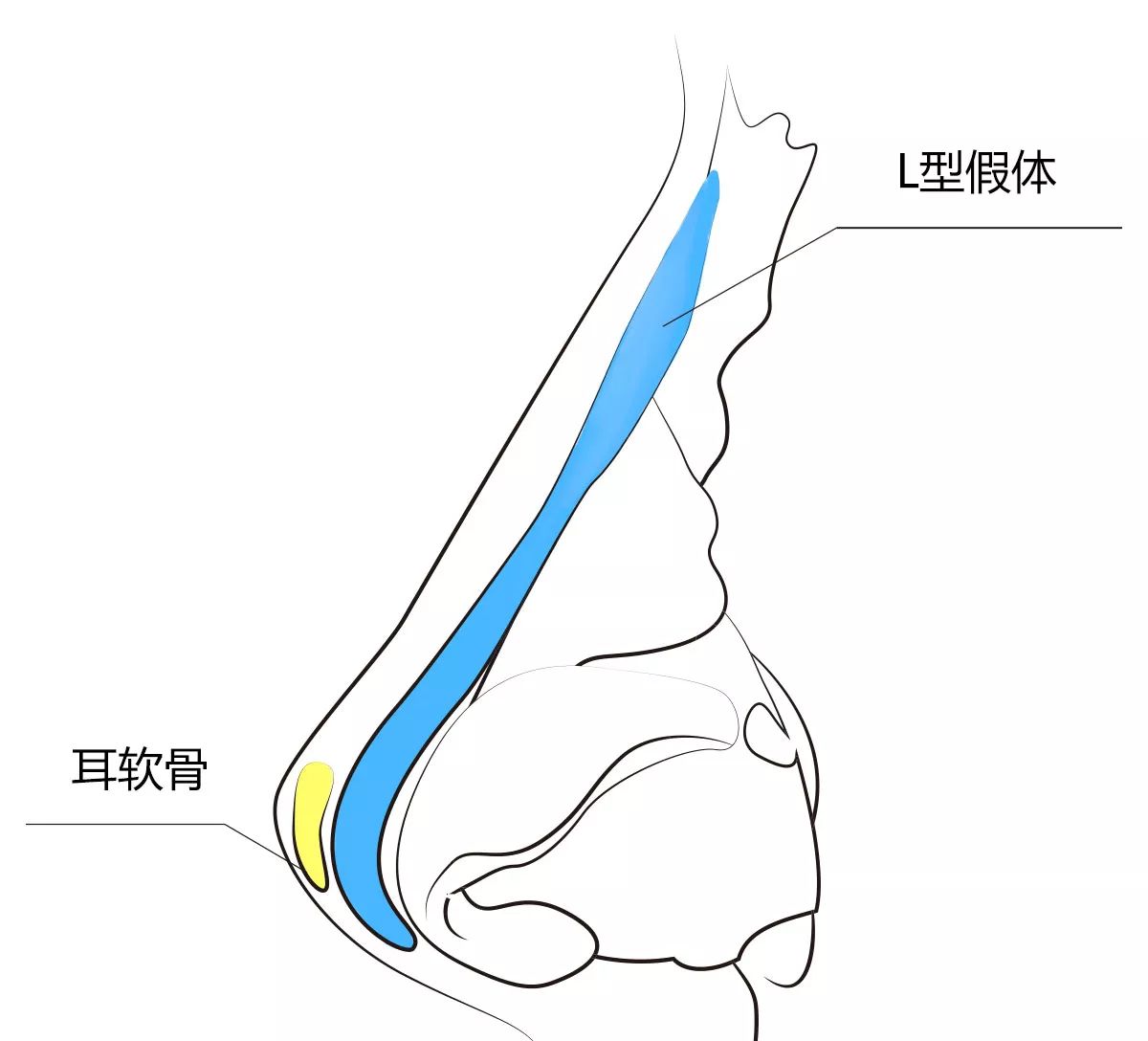 假体耳软骨鼻综合高挺翘美鼻是怎么做出来的