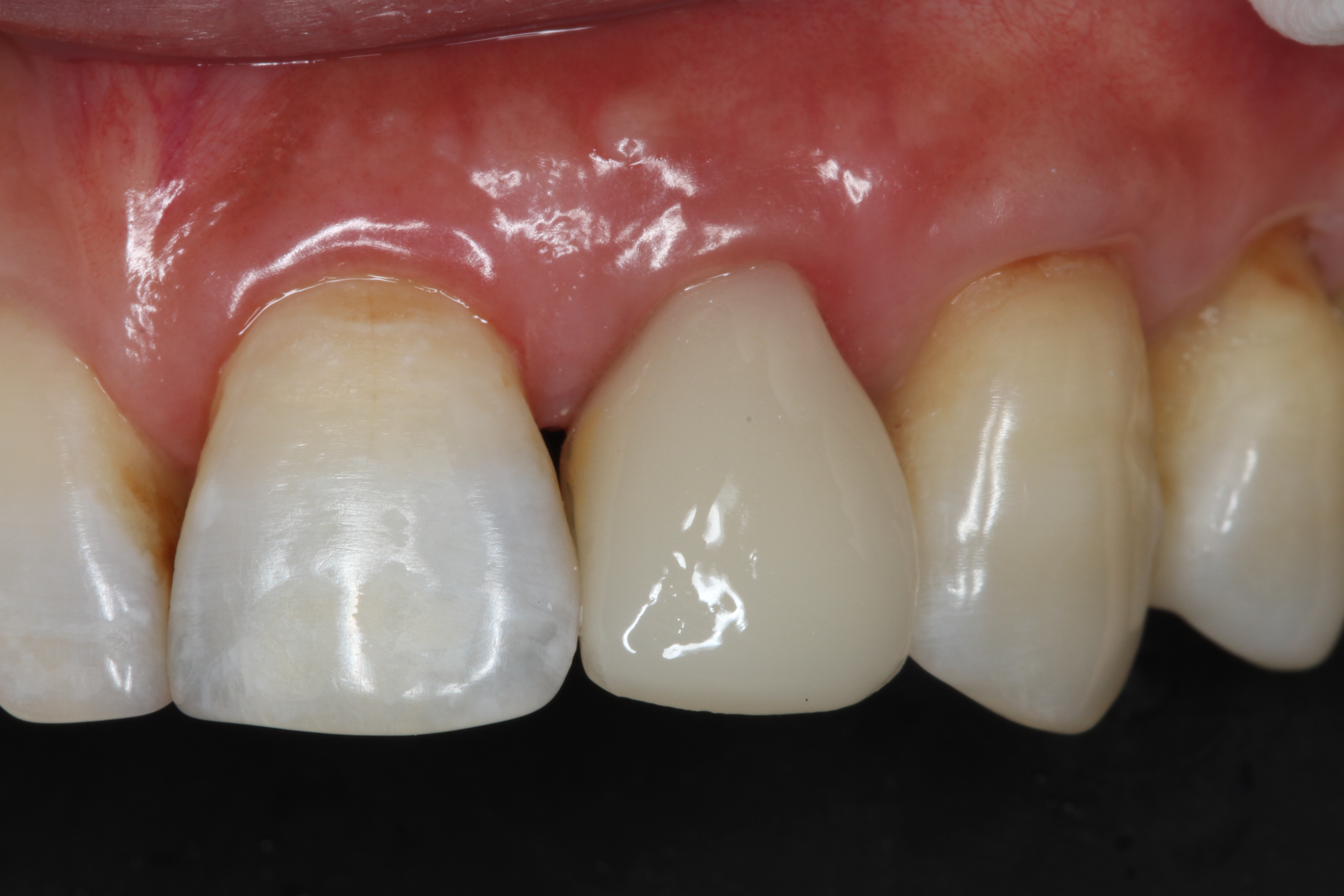 即刻修复瓷睿刻全瓷前牙美学修复案例