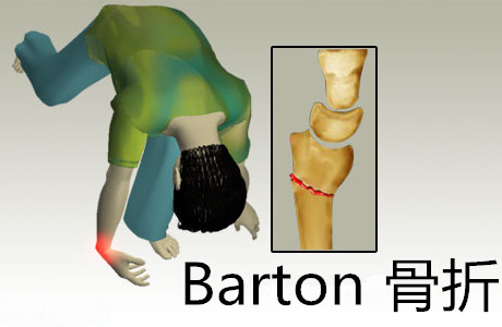 桡骨远端关节面纵斜型骨折,伴有腕关节脱位