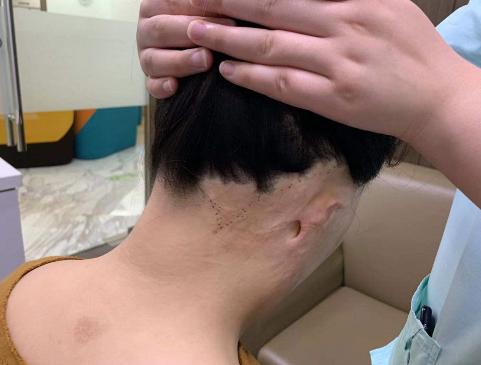 疤痕性脱发怎么解决