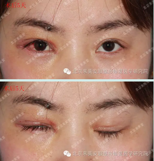 右侧上睑下垂矫正案例2012年12月21日顾客术前术后3年零9个月对比