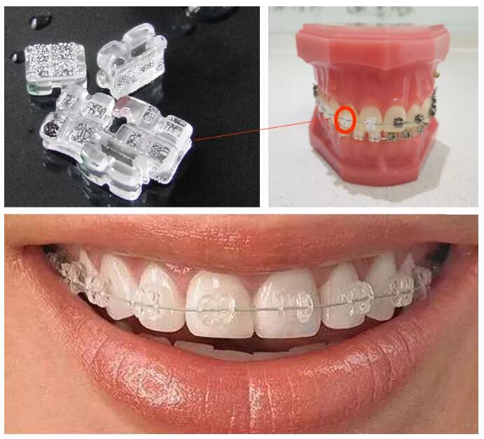 半隐形陶瓷托槽矫治器你嫌弃矫正托槽不美观稳定高效:先进的弓丝科技