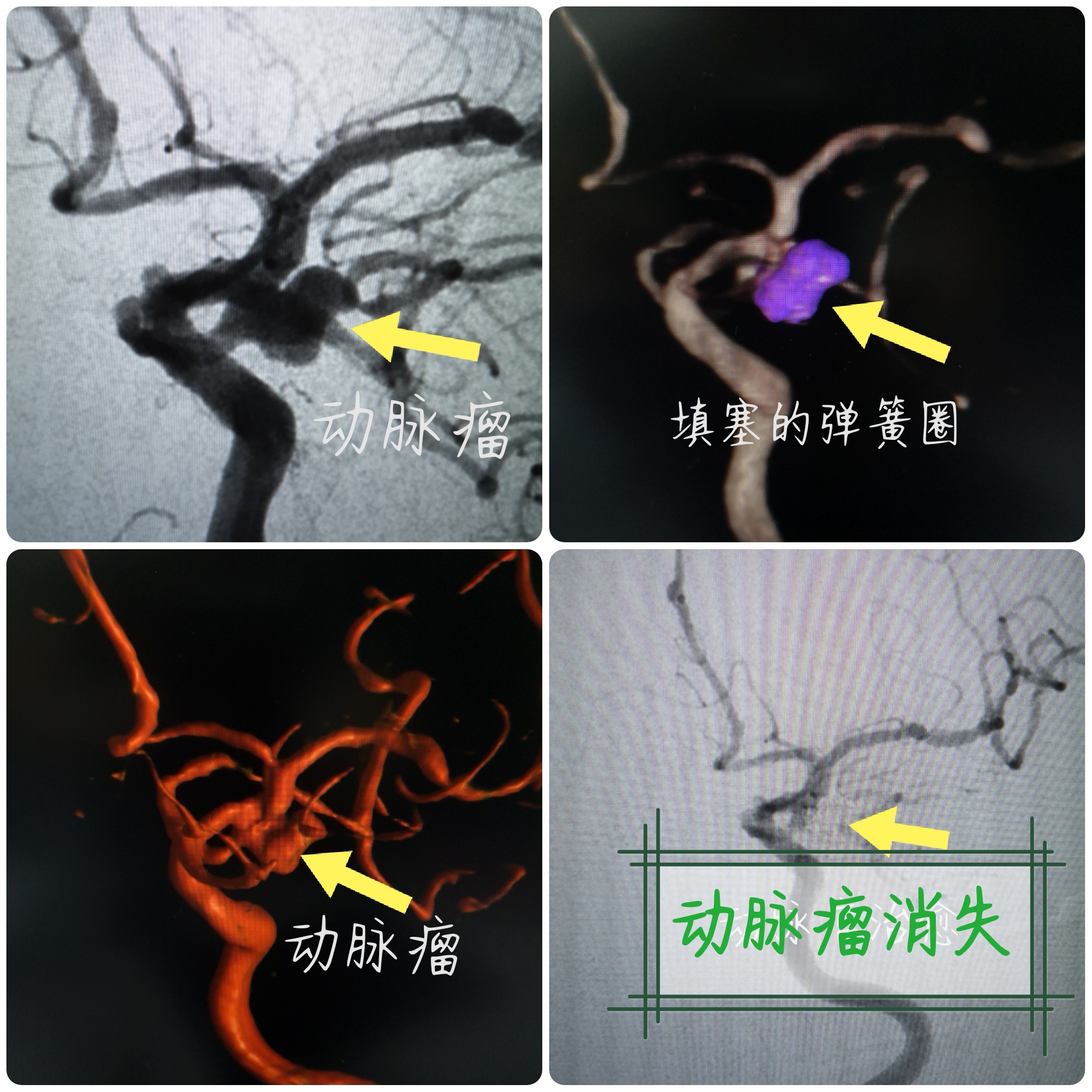 dr盖延廷|快好省治疗脑动脉瘤