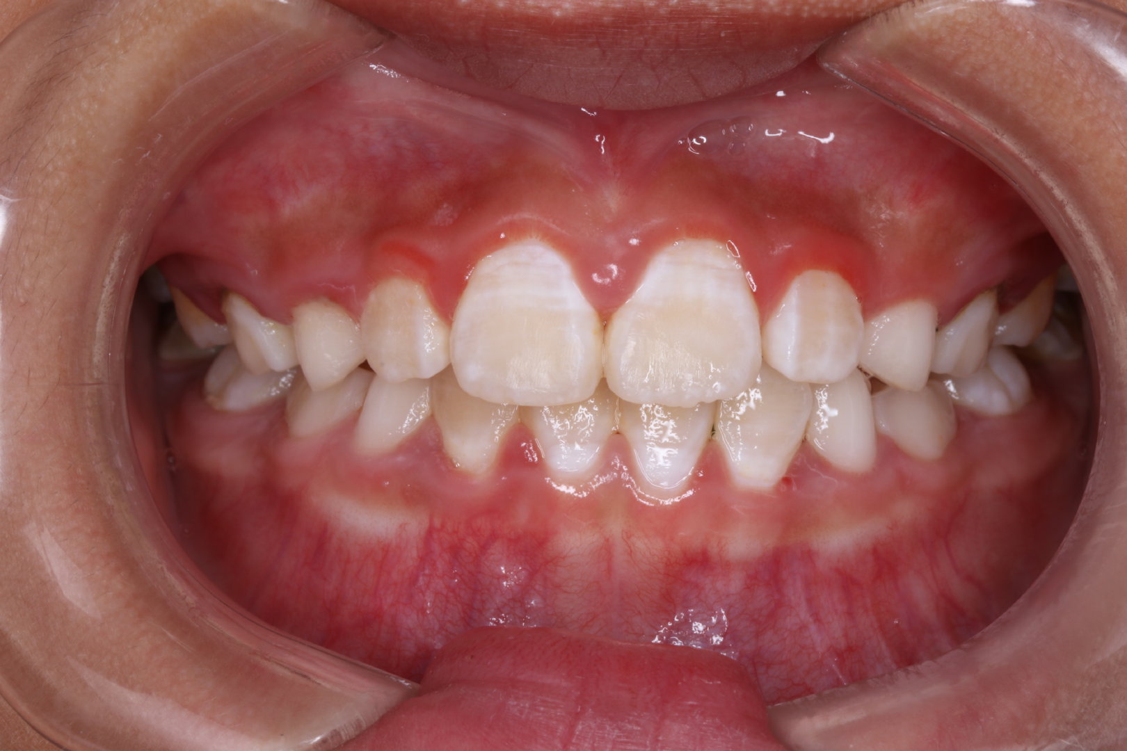 前牙畸形及散在间隙/瓷贴面修复 - 知乎