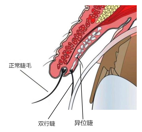 倒睫是什么及其成因