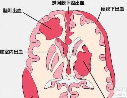 最常见的脑出血位置图图片
