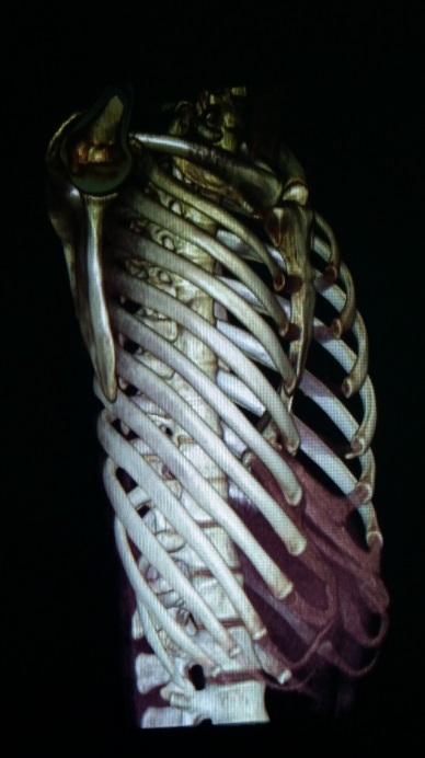 重度漏斗胸"超微创技术":大畸形,小手术