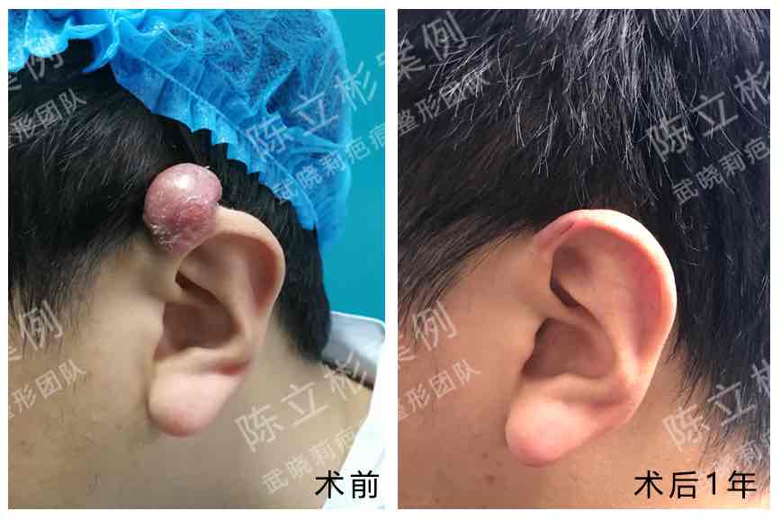 耳廓疤痕疙瘩术后1年余复诊