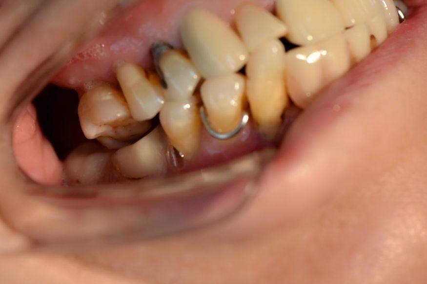 牙齿松动吃饭太遭罪能拔吗