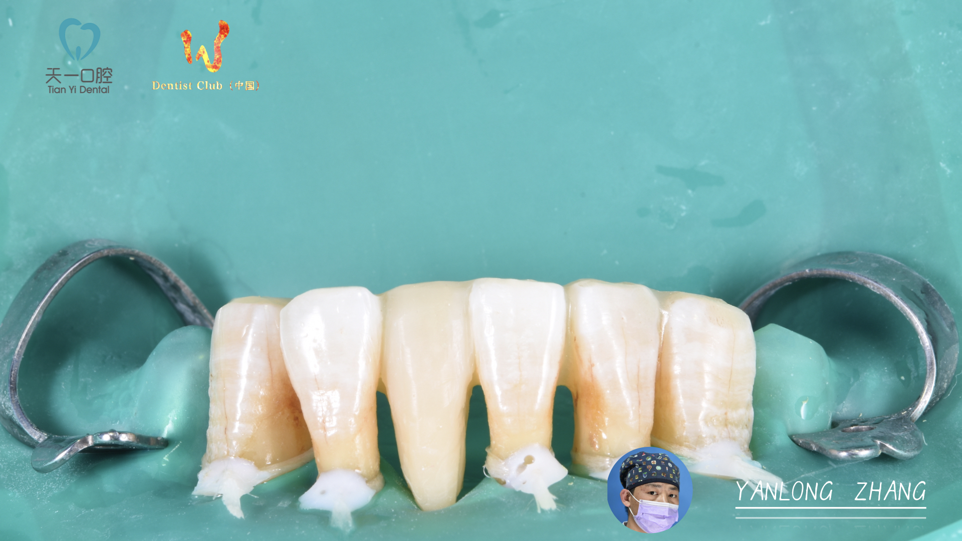 选择芬力粘接桥修复,恢复缺失前牙,重拾光辉岁月,还他幸福晚年!2.