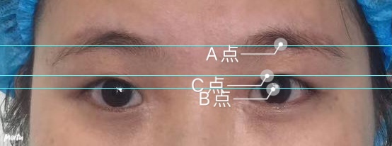 双眼皮改单或者降窄之后，眉眼间距是否会变远？