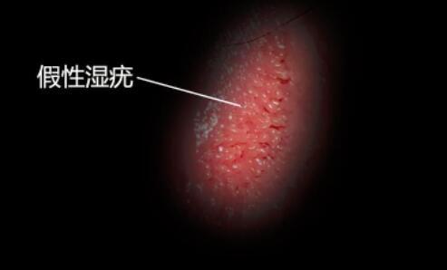 她们发现自己的外阴长了小米粒样的增生物,担心是尖锐湿疣.