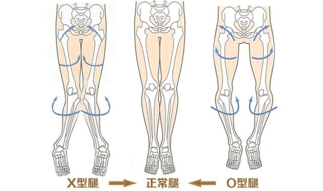 孩子腿型不直會不會有問題?兒童骨科醫生教你辨別需不需要治療