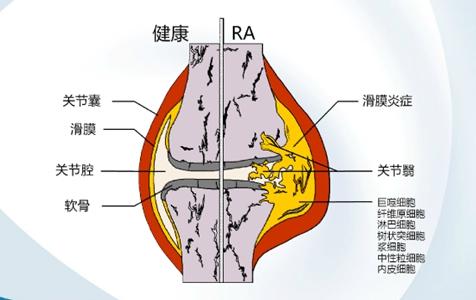 类风湿关节炎诊断的新标识