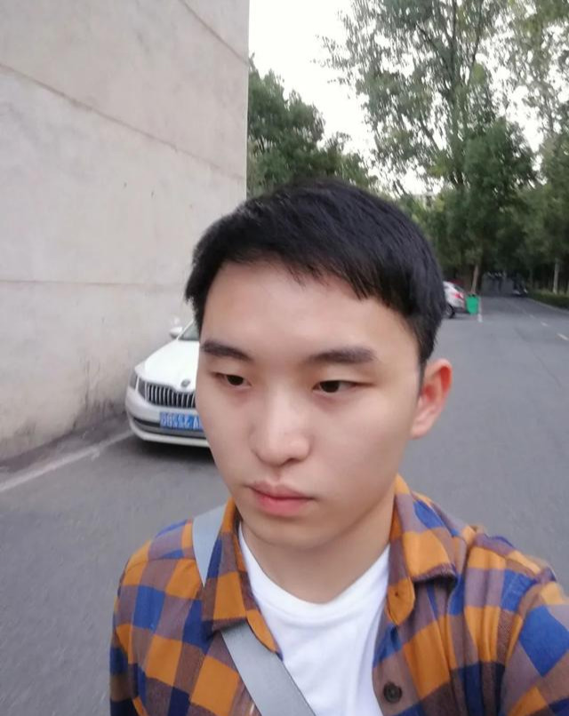乌克兰小伙植发(植发视频全部过程)