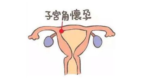 宫角妊娠的位置图片图片