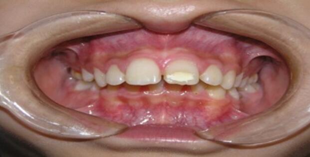 常见的错颌畸形有:牙齿扭转,龅牙,开合,深覆,地包天,牙列稀疏,牙列不