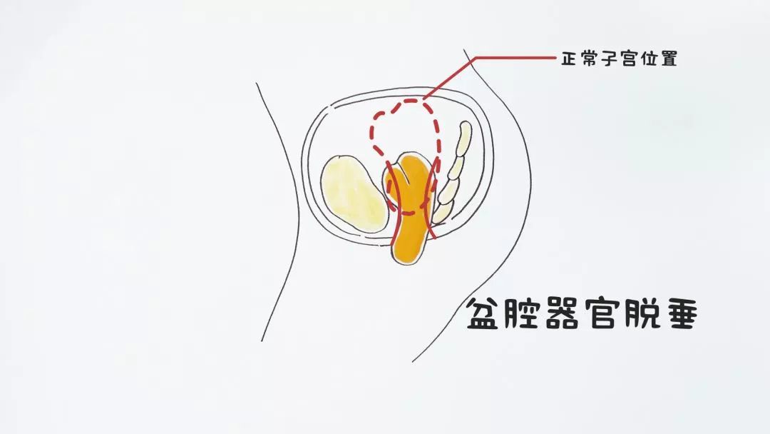 子宫溃疡图片