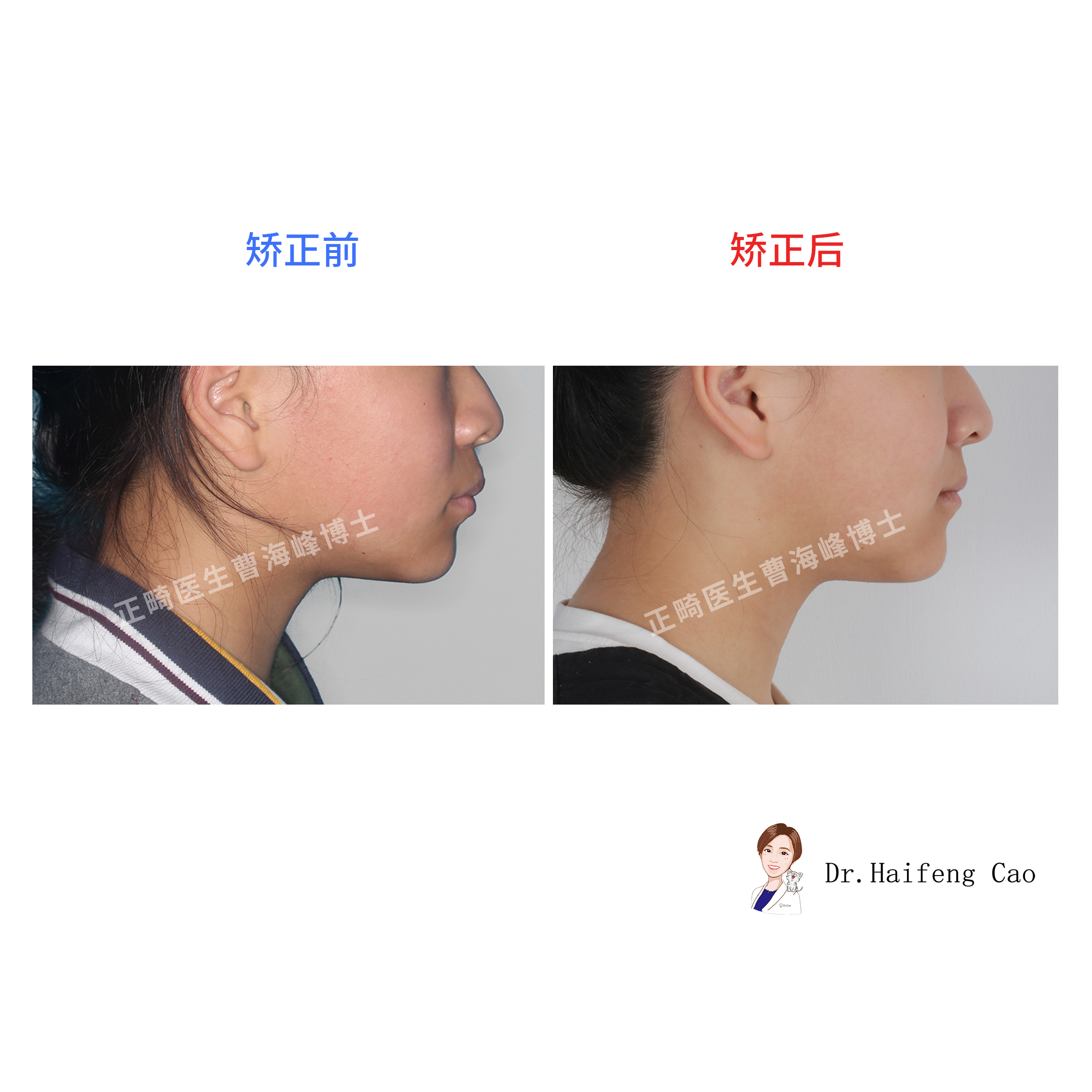 我院口腔颌面外科基于3D打印技术完成下颌骨精密重建成功填补省内空白-哈尔滨医科大学口腔医学院