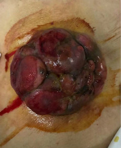 炎性乳腺癌案例图片图片