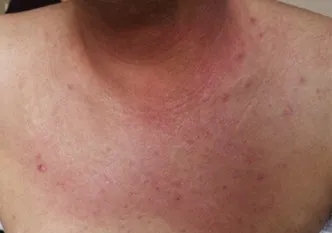 皮肌炎皮疹多久能消退?在外用药上有哪些选择?