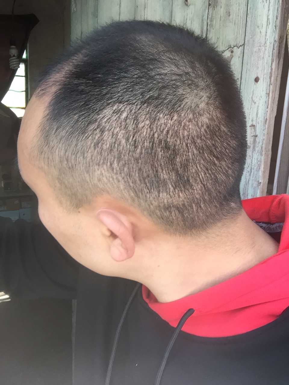 植发可以保持多少年?_刘学新_主治医师_爱问健康