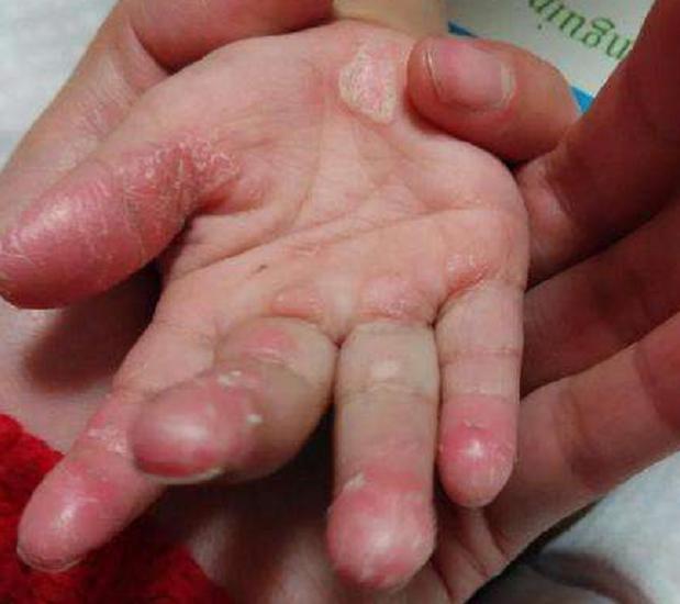 孩子手老蜕皮医生说可能和这三种病有关妈妈别大意