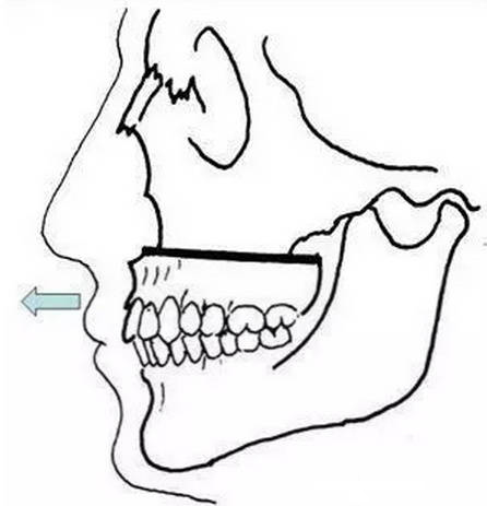嵴为中心,两侧的骨块前移,实际效果就是上颌骨lefort截骨前徙术的改良