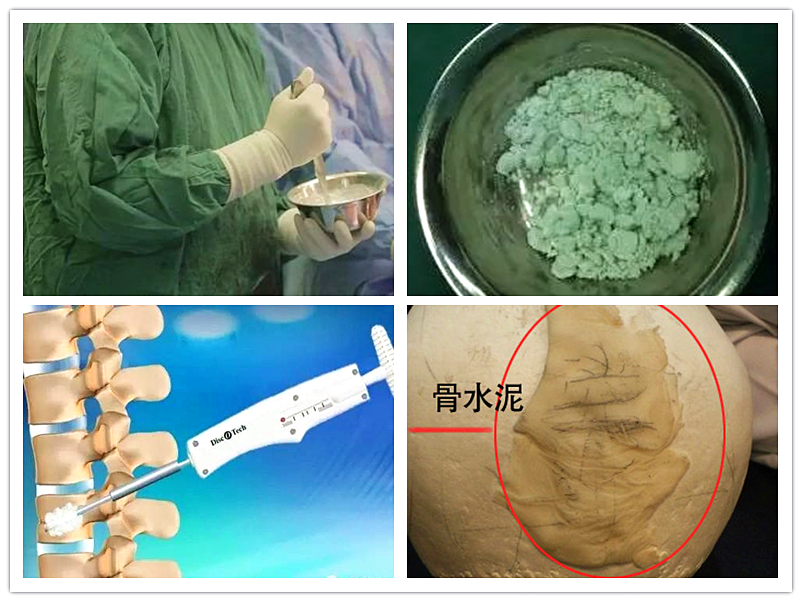 对于鼻背皮肤薄的求美者来说,如果打骨粉隆鼻的话,注射后遭受外力