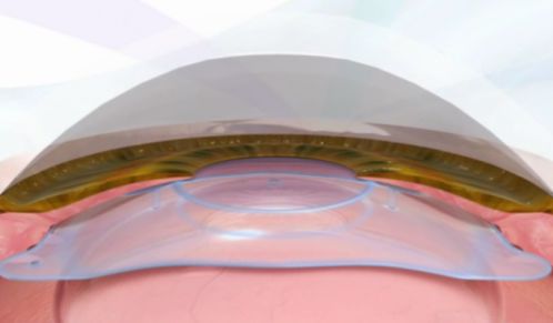 icl人工晶体和传统隐形眼镜,它并不覆盖在眼球表面,而是通过微创手术